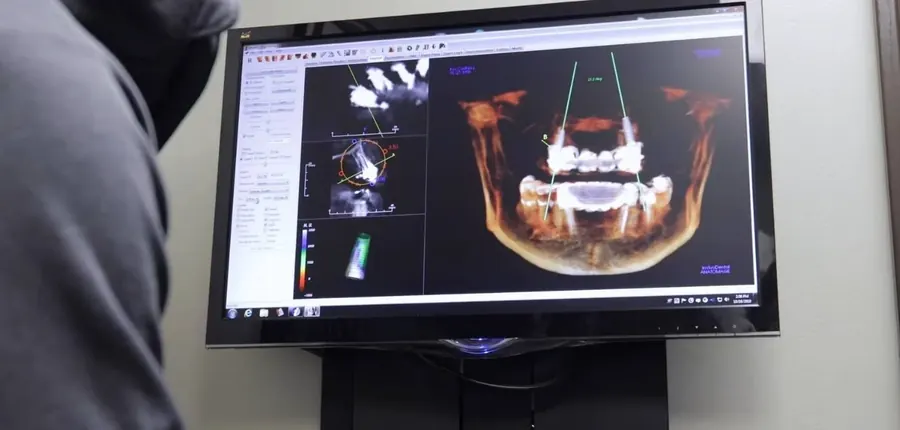 An implant plan on a 3-D cone beam scan of a patient's jaw, on a monitor at Northbrook Dental Group.