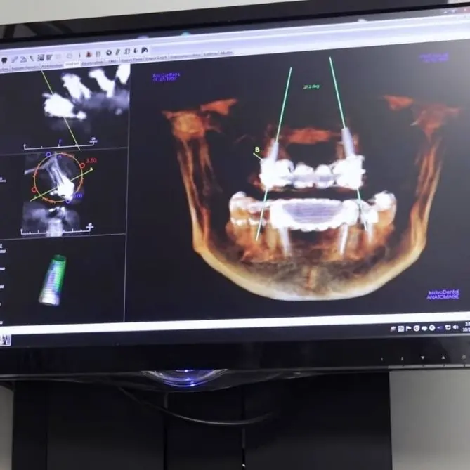 A 3-D cone beam scan used to plan dental implants, on a monitor in the office.